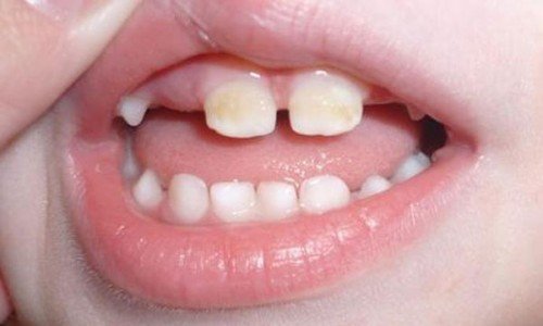Бутылочный кариес у детей: следите за состоянием зубов малыша с рождения